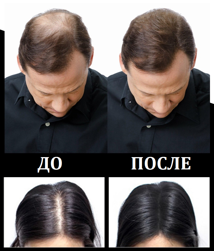 Загуститель волос Toppik фото до и после использования